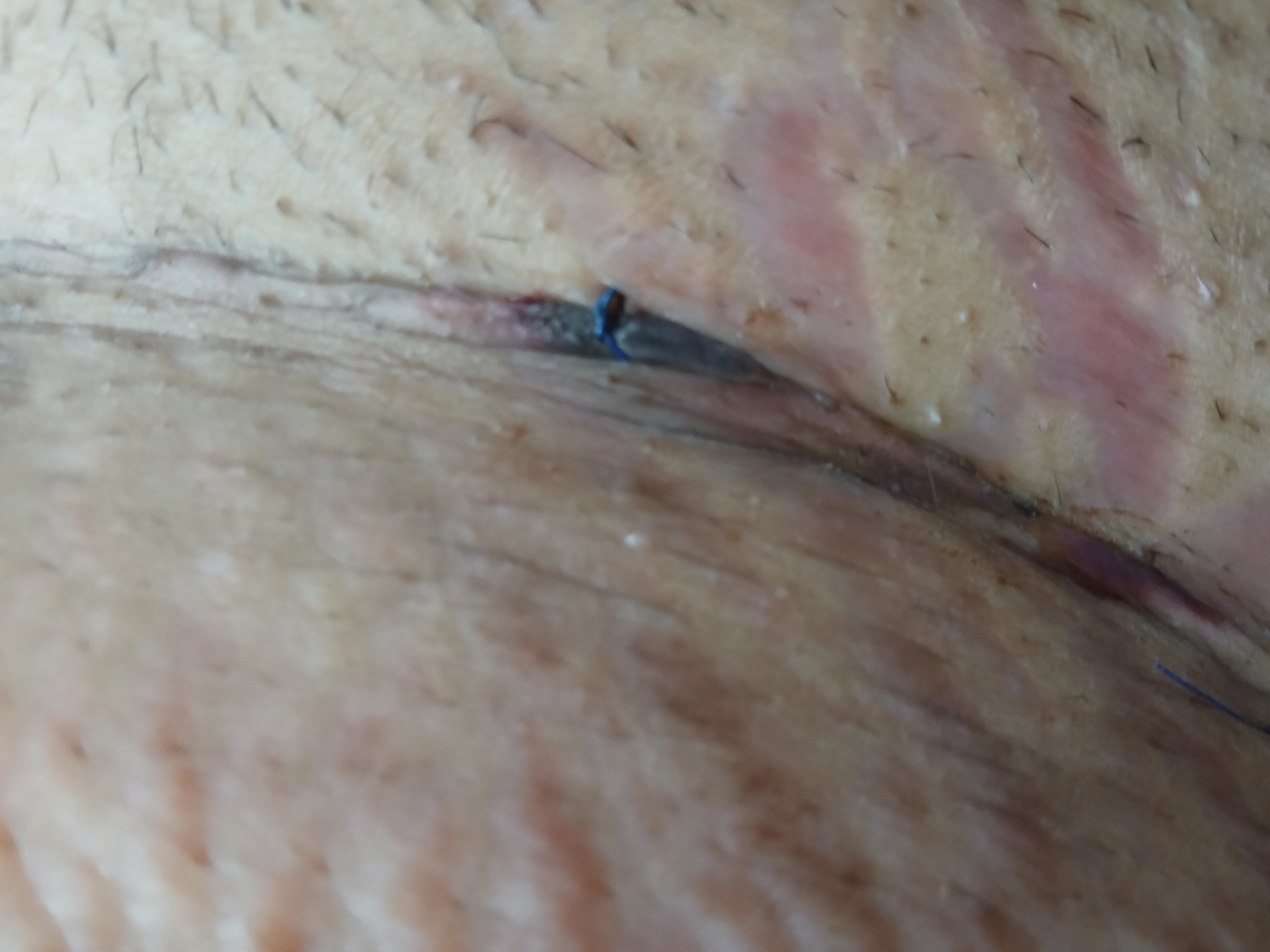 زخم بخیه آیا نرمال هست؟