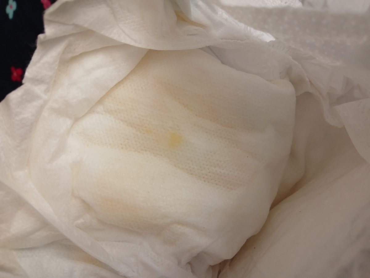 تفسیر آزمایش دیدن ترشح زرد مانند در ادرار نوزاد