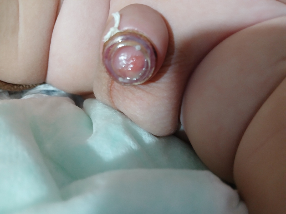 آیا این ختنه عفونت کرده؟؟