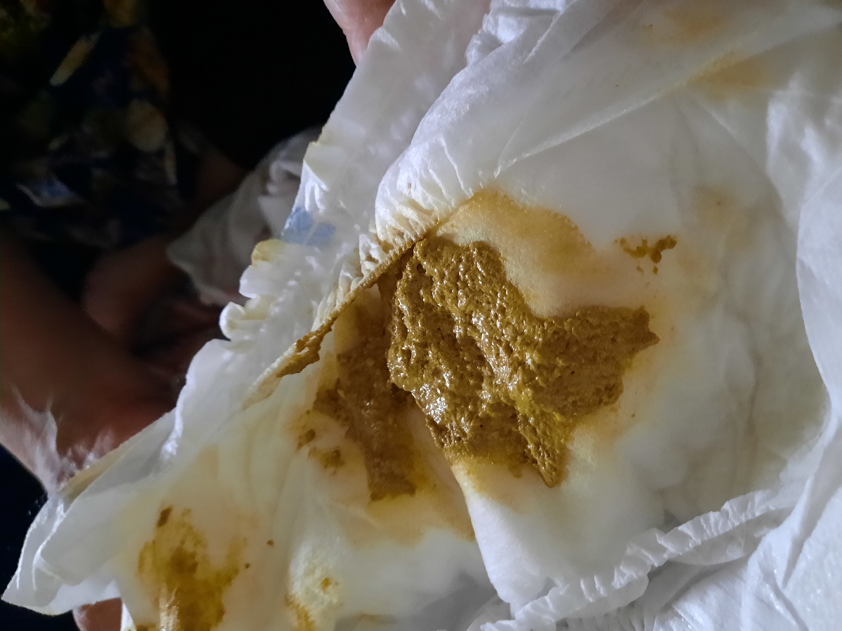 عکس مدفوع نوزاد ایا خلطی هست