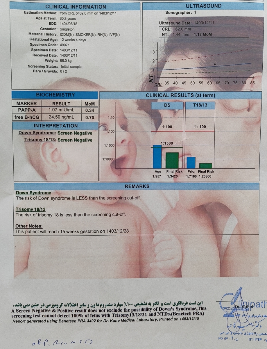 استخوان بینی کوتاه در آنومالی با جواب آزمایش سلفری بدون مشکل استخوان بینی کوتاه در آنومالی با جواب آزمایش سلفری بدون مشکل
