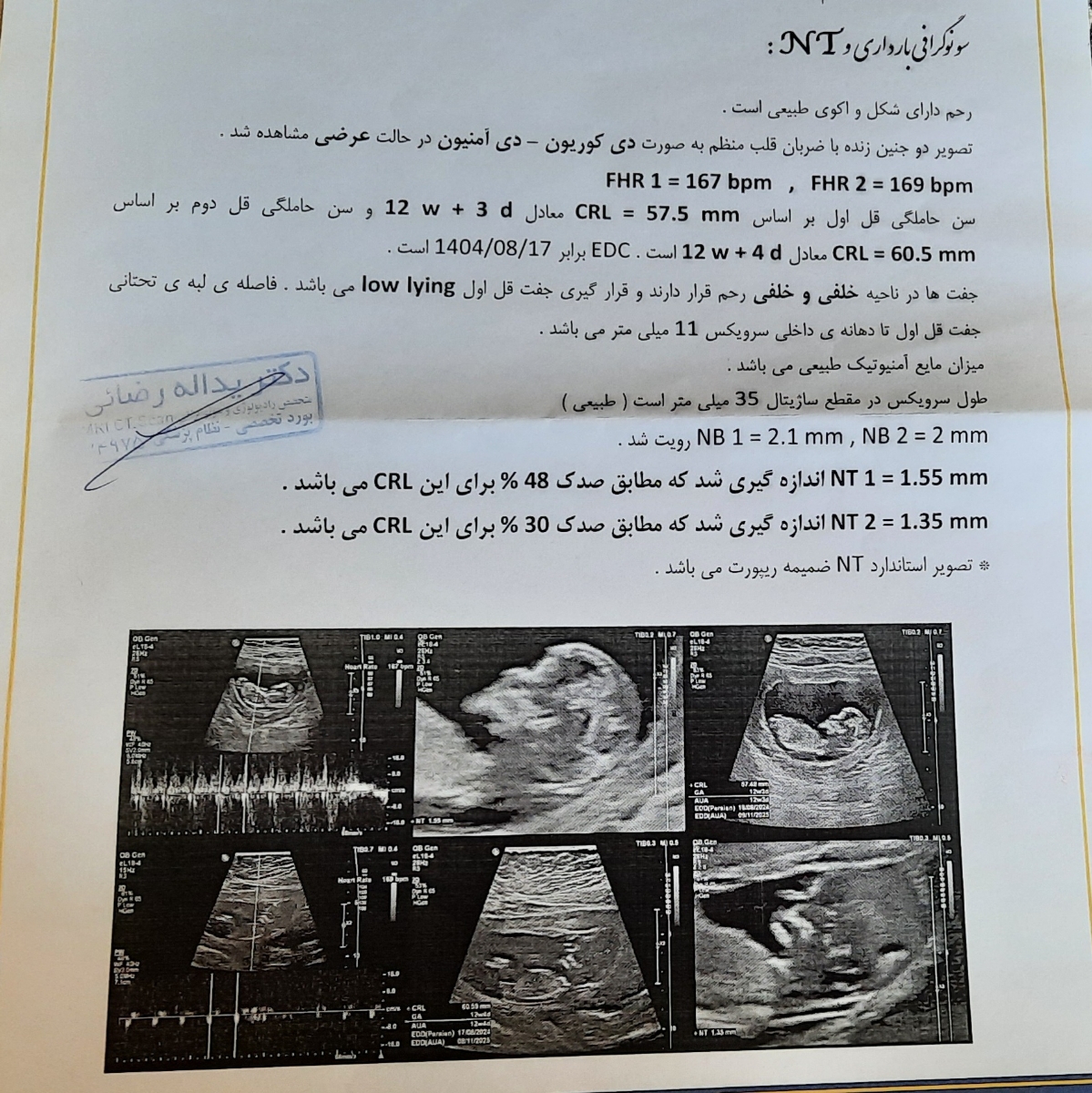 سونو گرافی nt سونو گرافی nt