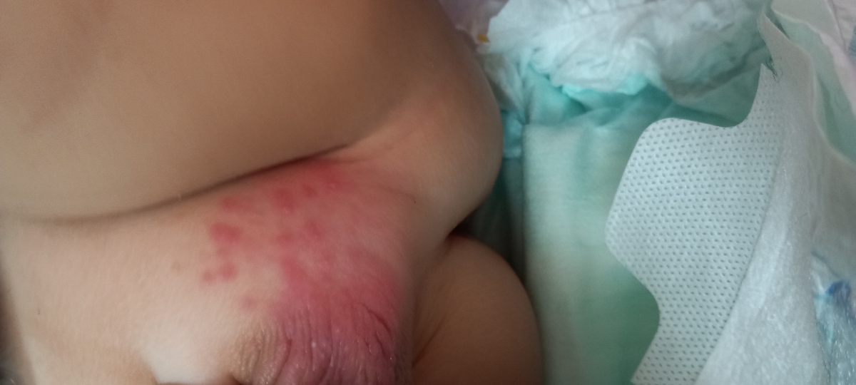 درمان جوش روی آلت نوزاد 13 ماه درمان جوش روی آلت نوزاد 13 ماه