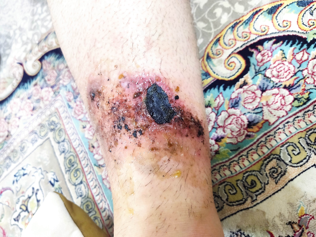 سوختگی پا با چایی