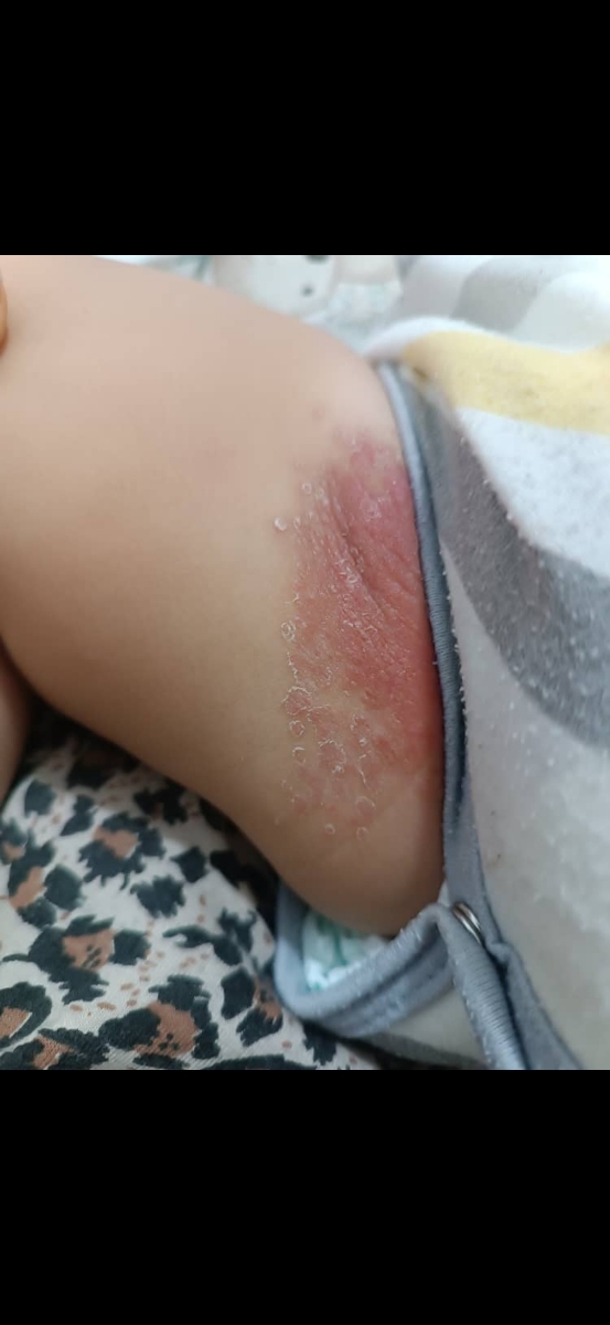 پای پسردوستم ک 6 ماهشه اینطوری سوخته پای پسردوستم ک 6 ماهشه اینطوری سوخته