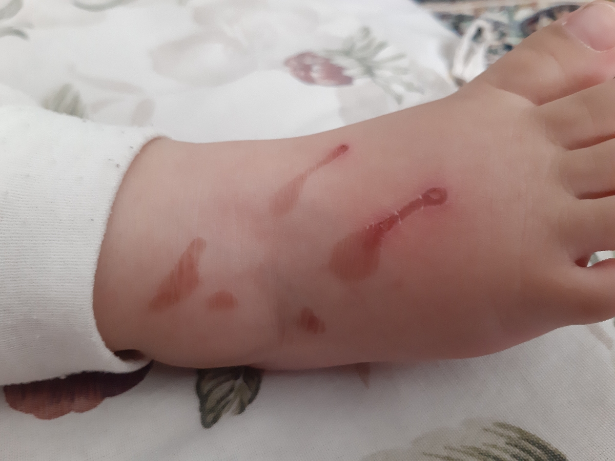 چه پمادی برای سوختگی استفاده کنم؟
