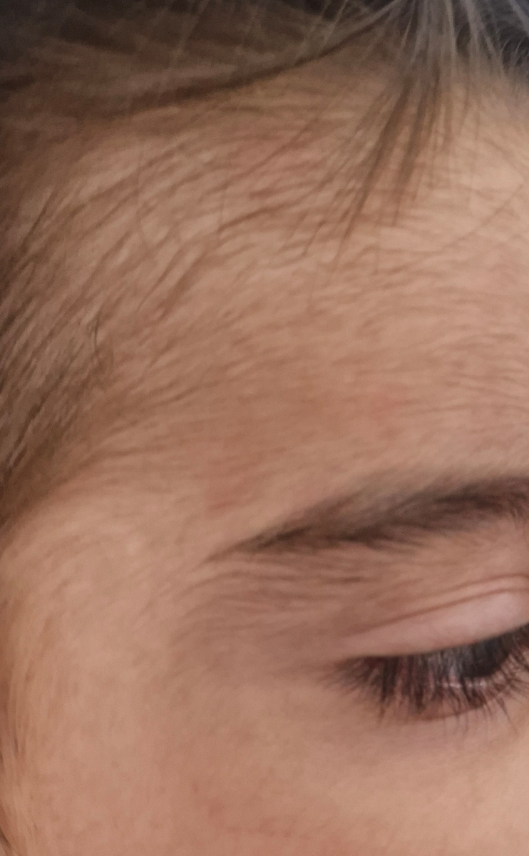 بثورات پوستی روی گردن بثورات پوستی روی گردن