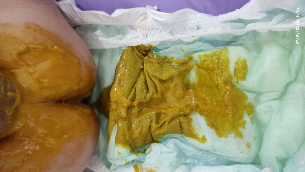 ایا این مدفوع نوزاد خلطی است؟