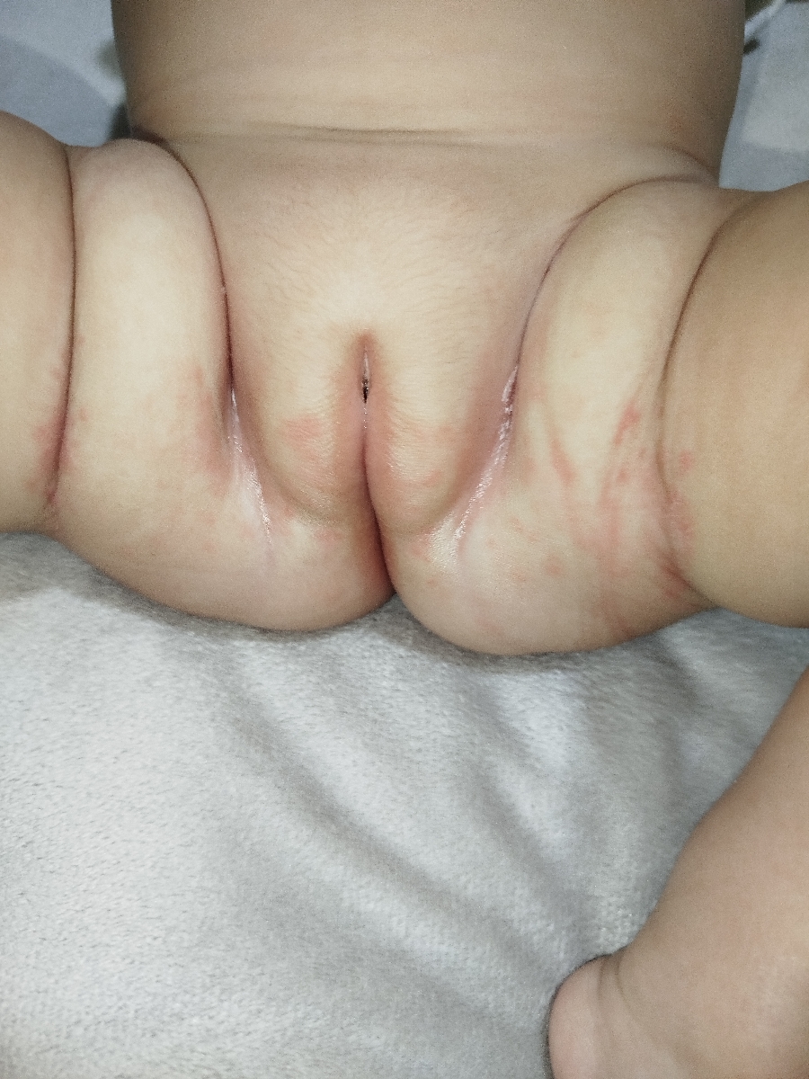 علت التهاب و جوش ریز قسمت واژینال و کشاله ران نوزاد