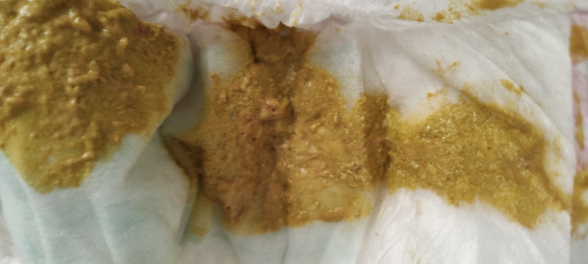رگه خونی داخل مدفوع نوزاد