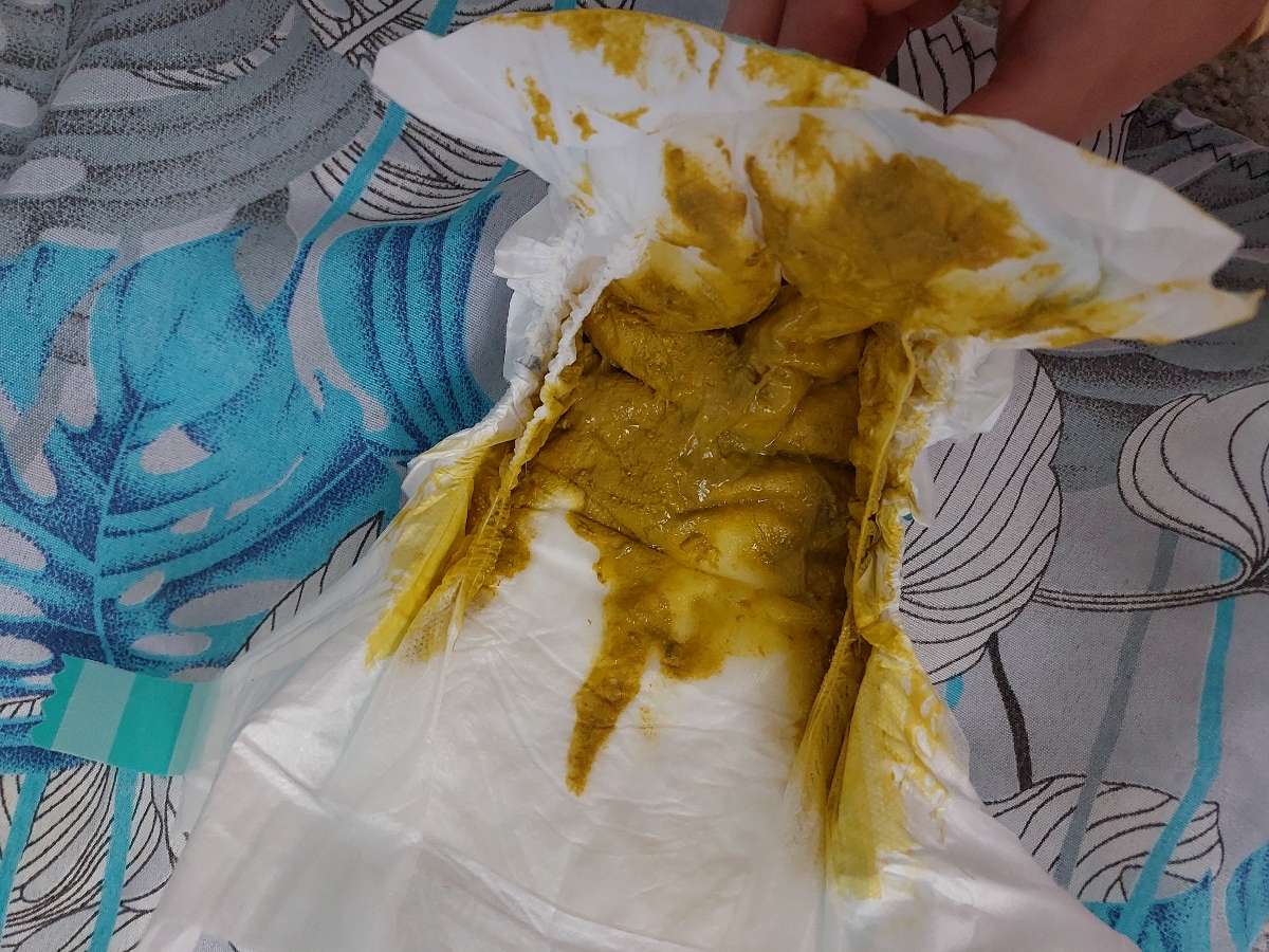 مدفوع خلطی نوزاد دوماهه و وزن پایین مدفوع خلطی نوزاد دوماهه و وزن پایین