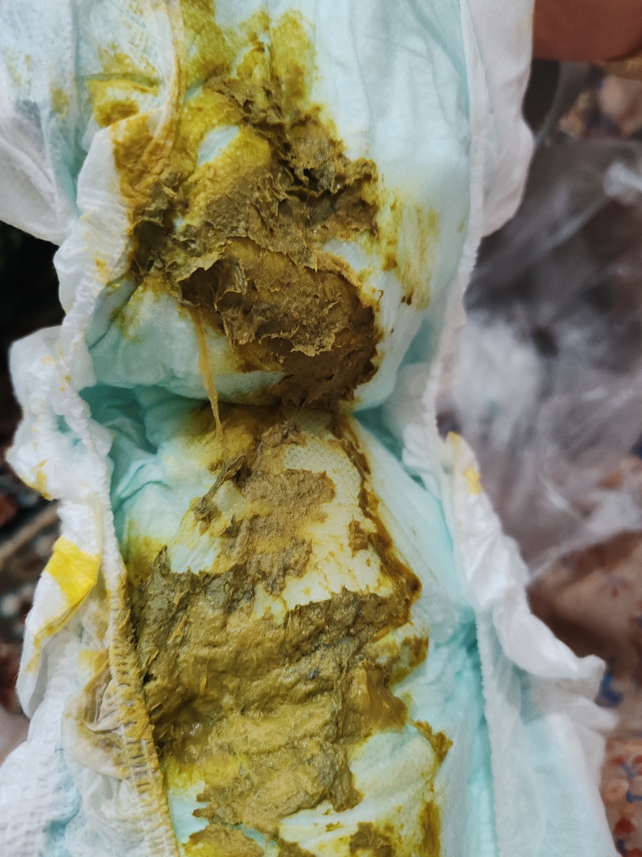 نحوه دفع روده در نوزاد 6 ماهه چطور باید باشه؟