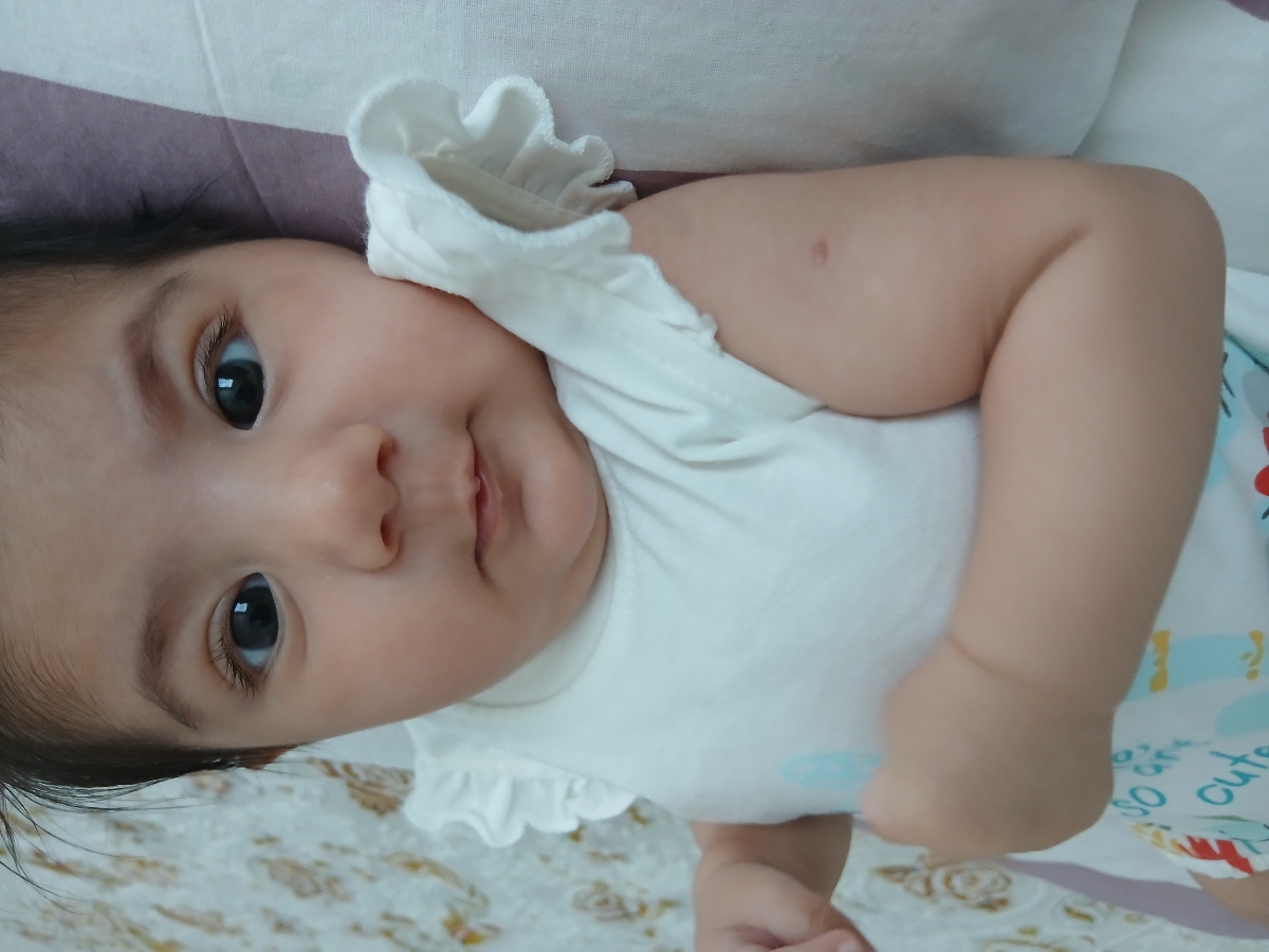 انحراف چشم نوزاد سه ماهه