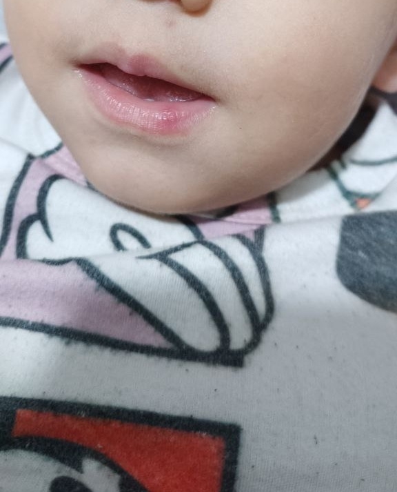 سلام وقتتون بخیر این تبخال پسرم زده ؟😭 سلام وقتتون بخیر این تبخال پسرم زده ؟😭