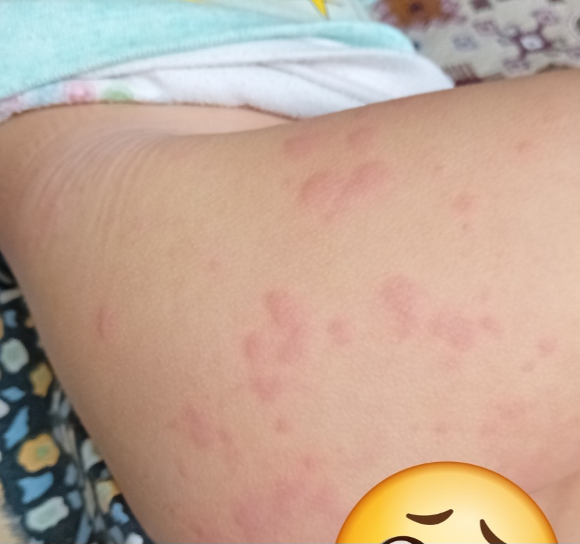 حساسیت غذایی هم اینطوری هس اول چندتاست بعدرفته رفته بیشتری میشه حساسیت غذایی هم اینطوری هس اول چندتاست بعدرفته رفته بیشتری میشه