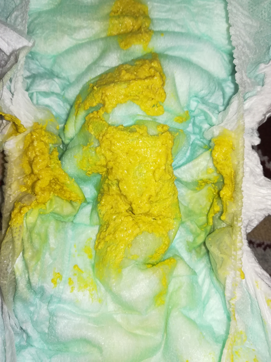 اسهال ناشی از تغییر شیر خشک یا مصرف دایمتیکون و اهورا نی نی اسهال ناشی از تغییر شیر خشک یا مصرف دایمتیکون و اهورا نی نی