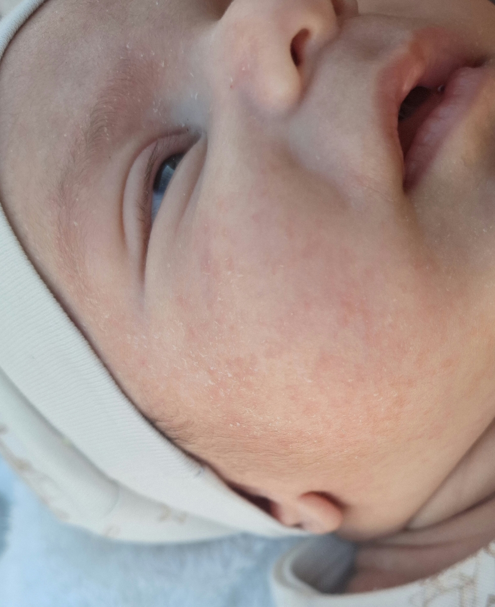 خشکی پوست صورت نوزاد خشکی پوست صورت نوزاد