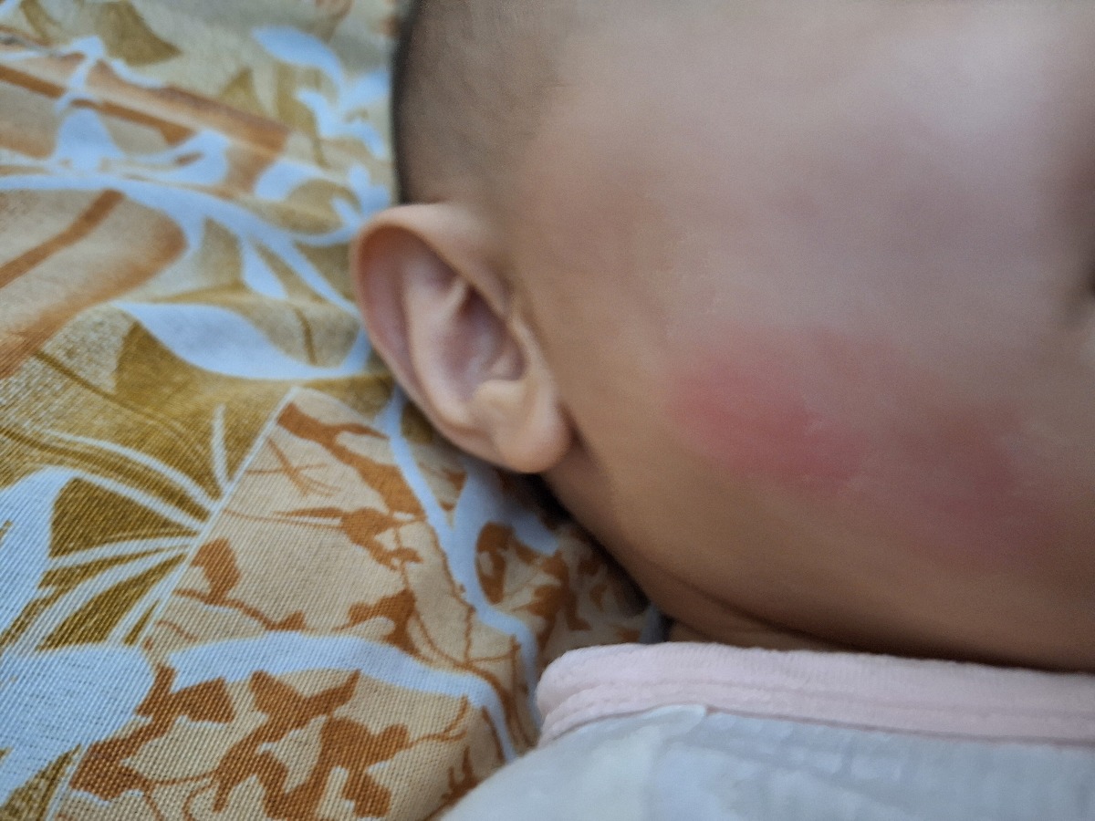 اگزما در دختر ۸ ماهه