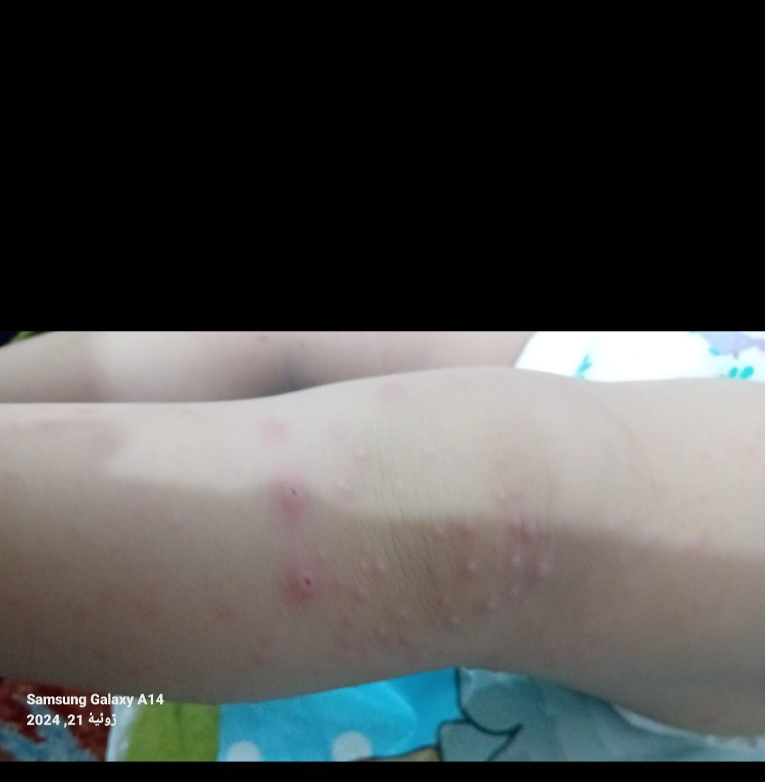 آمپول کلرفنیرامین برا دو ساله میشه زد آمپول کلرفنیرامین برا دو ساله میشه زد