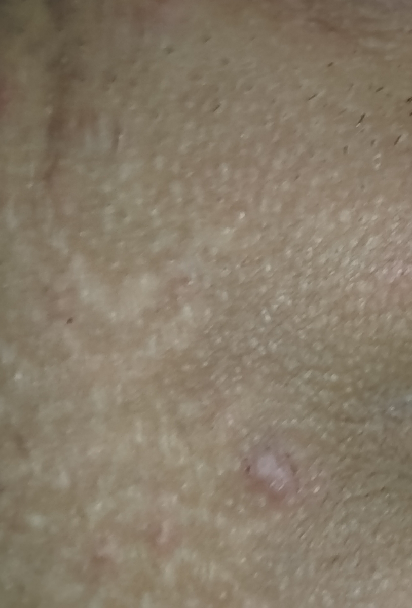 زگیل تناسلی عکس زگیل تناسلی عکس