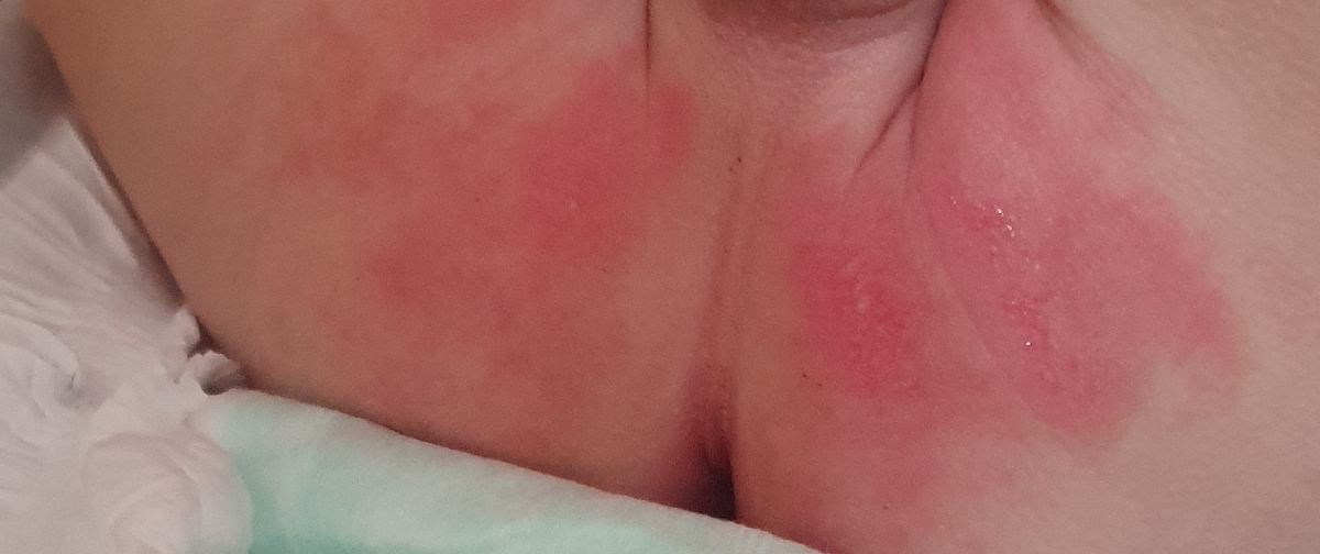 سوختگی ناحیه تناسلی کودک ۱۱ ماهه سوختگی ناحیه تناسلی کودک ۱۱ ماهه