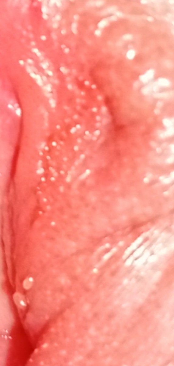 تبخال تناسلی و استرس
