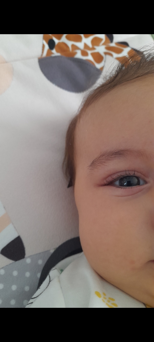 قرمزی چشم نوزاد و خارش قرمزی چشم نوزاد و خارش