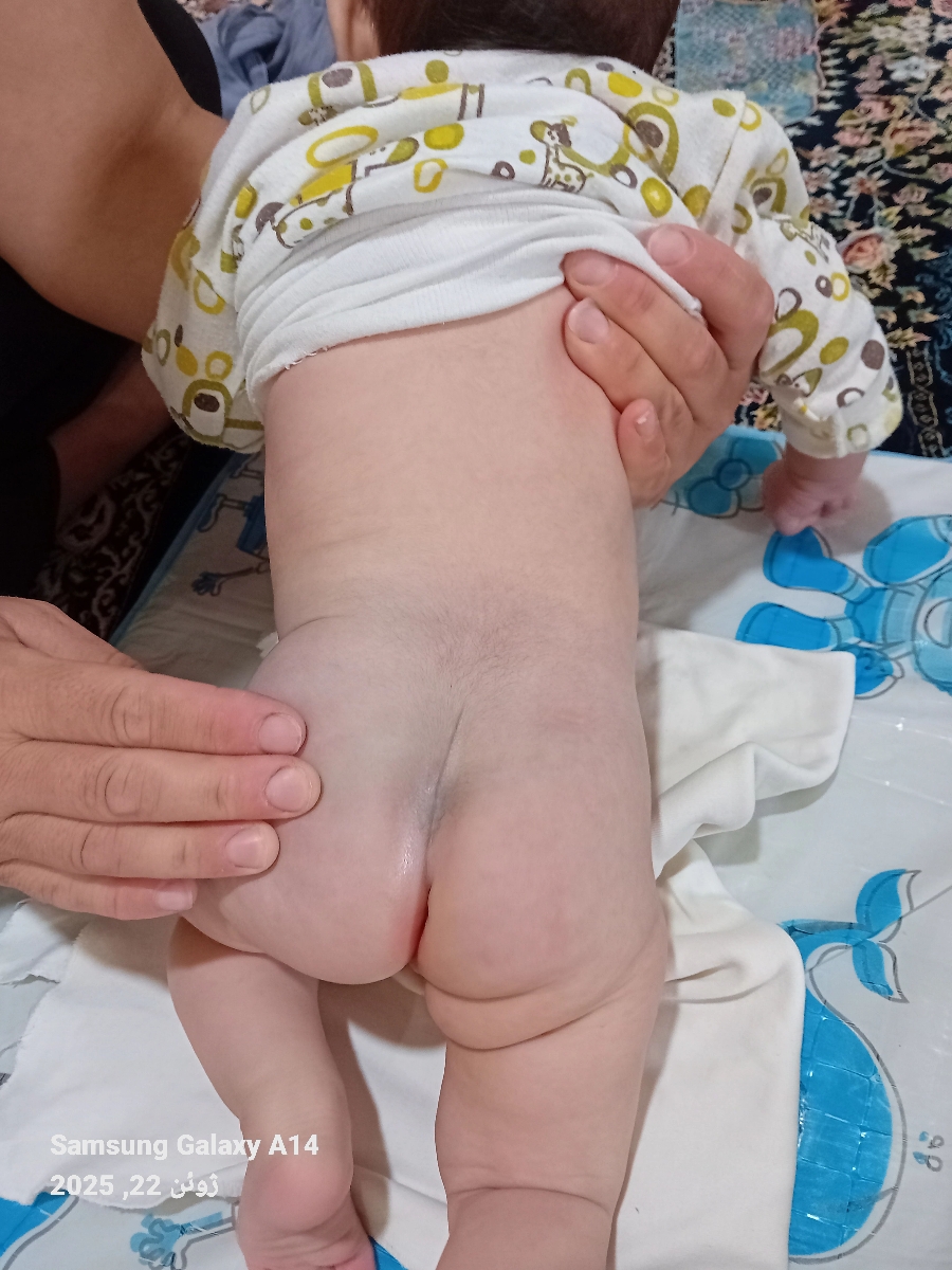 کبودی کمر و باسن نوزاد