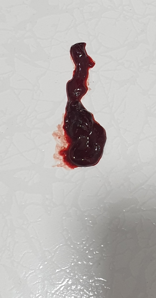 خون ریزی و لخته. خون ریزی و لخته.