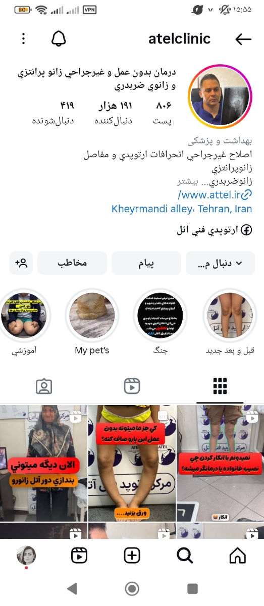 زانوی ضربدری کودک ۲۲ ماهه زانوی ضربدری کودک ۲۲ ماهه