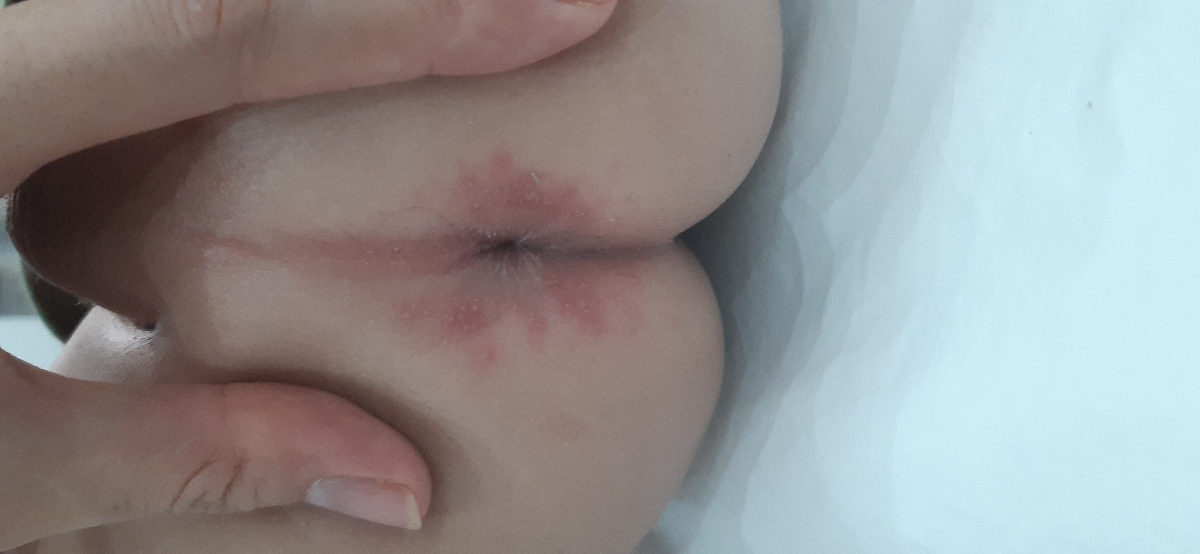 سوختگی مقعد بچه سوختگی مقعد بچه