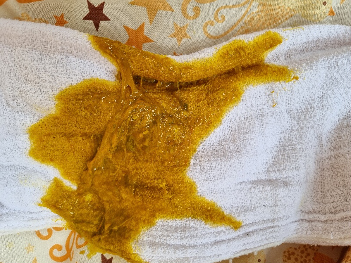 مدفوع نوزاد ۴ ماهه ..خلطی ..حاوی عکس مدفوع نوزاد ۴ ماهه ..خلطی ..حاوی عکس