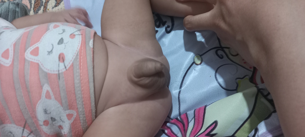 حالت باد درقسمت پایین آلت بچه علتش چیه؟