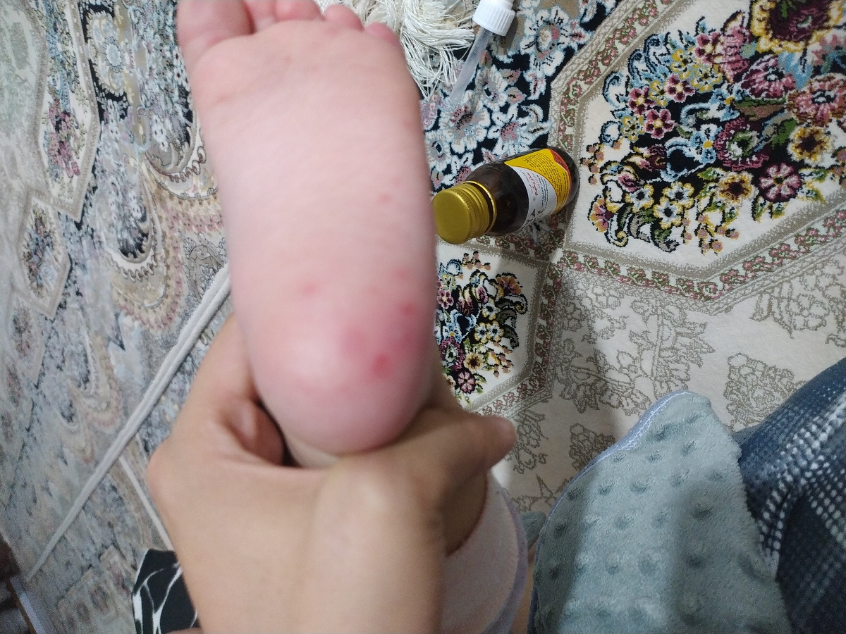 پاهای دخترم اینجوری شده