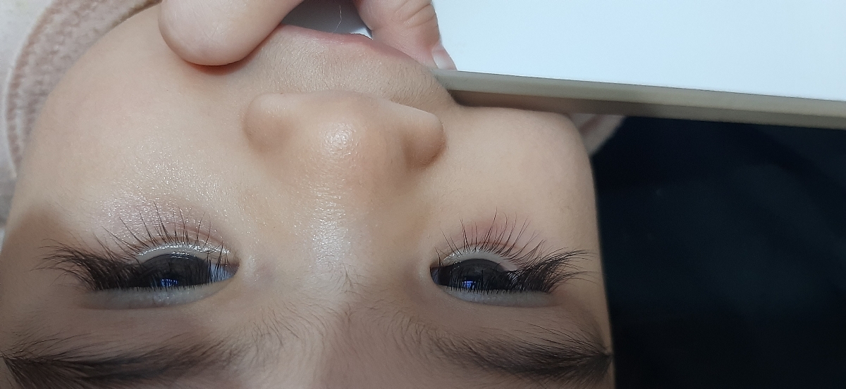 دلیل قرمزی گودی زیر چشم نوزاد ۱۰ ماهه دلیل قرمزی گودی زیر چشم نوزاد ۱۰ ماهه