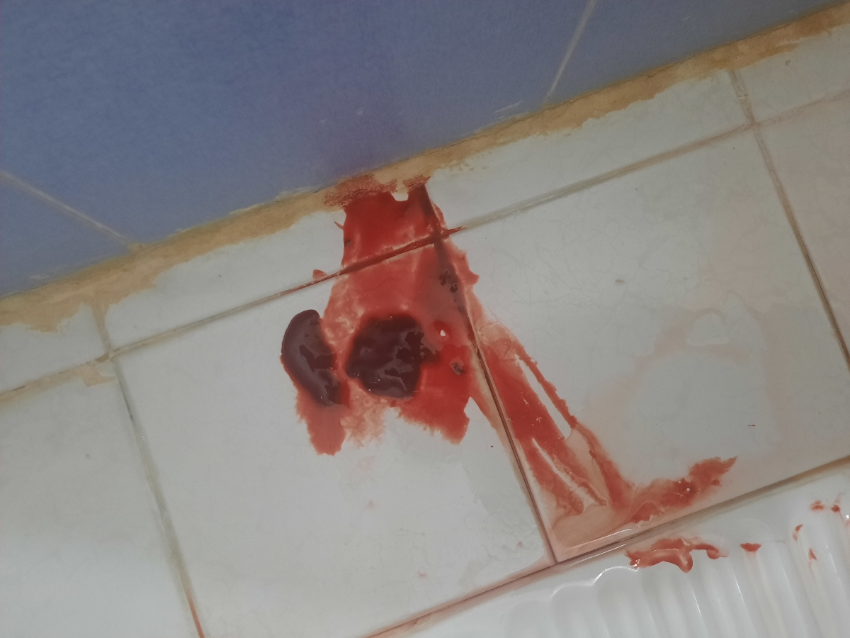 دکتر احتمال بارداری خارج رحمی داده قرص یدوفولیک گفت بخورم