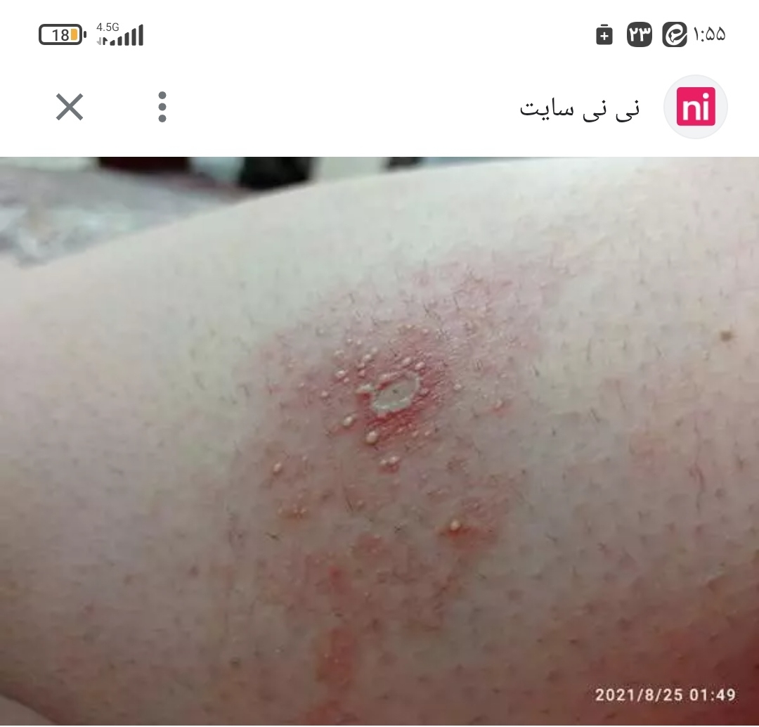 دانه تاولی شکل دانه تاولی شکل