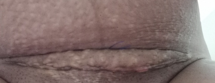ورم زیر بخیه سزارین