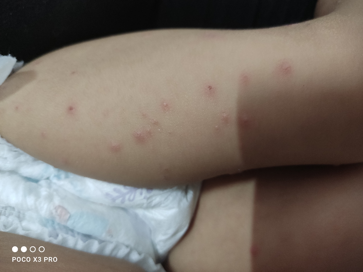 دونه های آبدار روی بدن کودک 1.5ساله