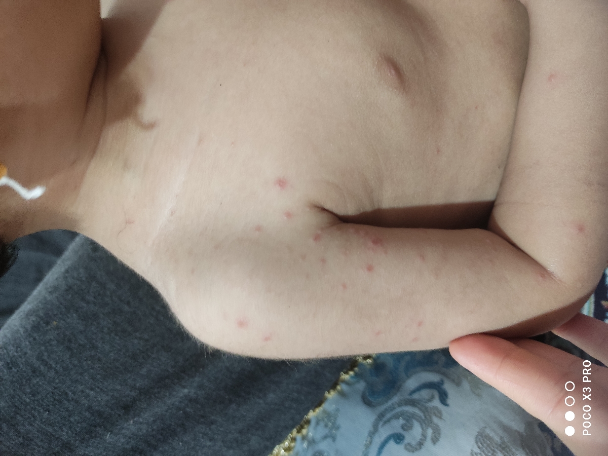 دونه های آبدار روی بدن کودک 1.5ساله