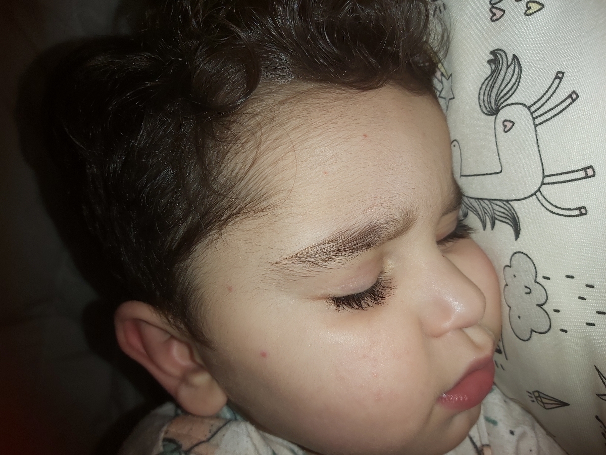 علائم سرخک بچه ها