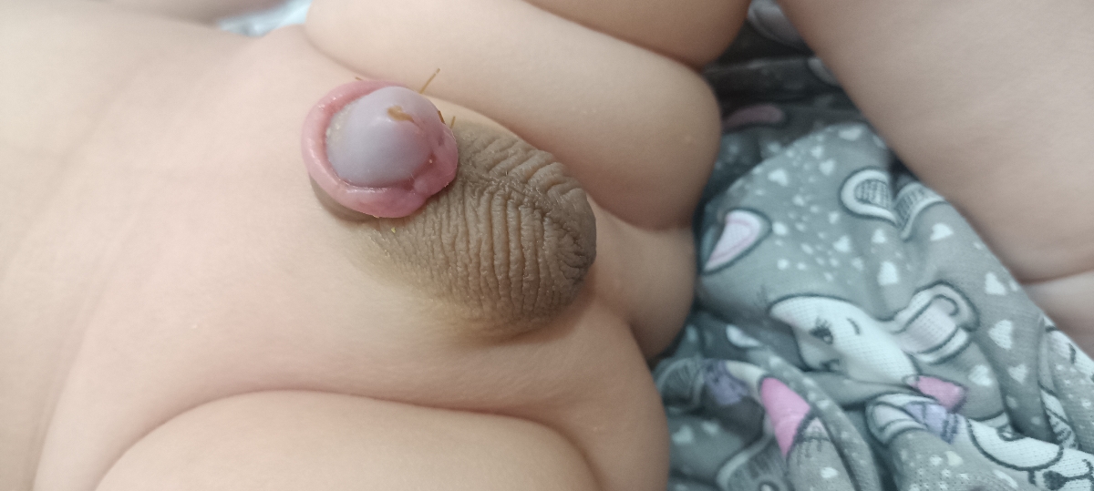 ختنه نوزاد سه ماهه