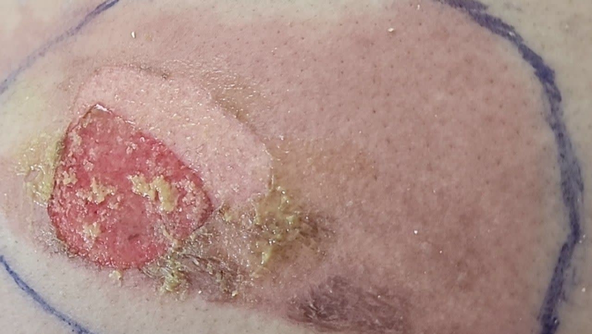 سوختگی با آبجوش در دوران شیردهی سوختگی با آبجوش در دوران شیردهی