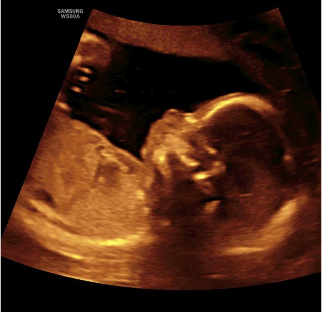 بررسی سونوگرافی انومالی