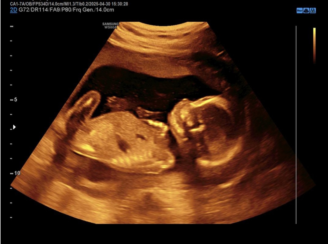 بررسی سونوگرافی انومالی