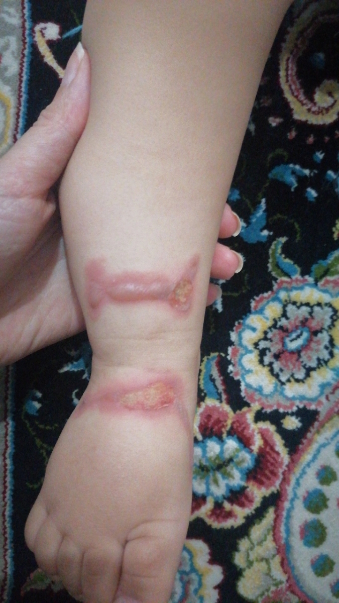 سوختگی پا بچه 9 ماهه
