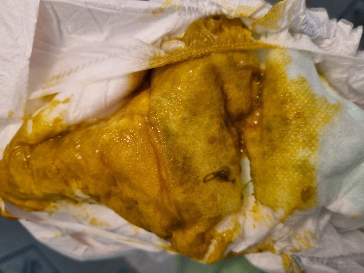 اسهال و خلطی بودن دفع نوزاد ۴ ماهه اسهال و خلطی بودن دفع نوزاد ۴ ماهه
