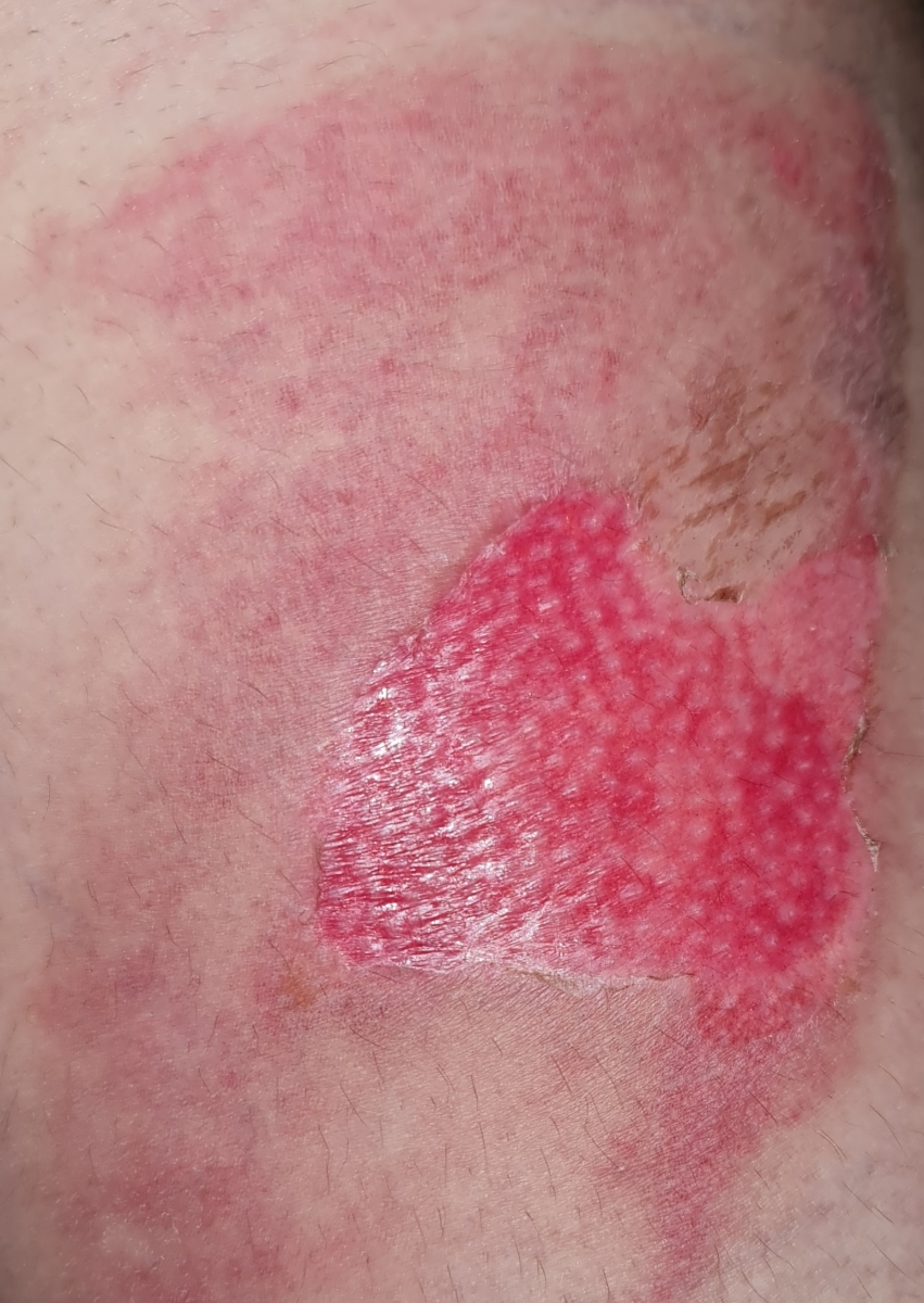 سوختگی با آبجوش در دوران شیردهی سوختگی با آبجوش در دوران شیردهی