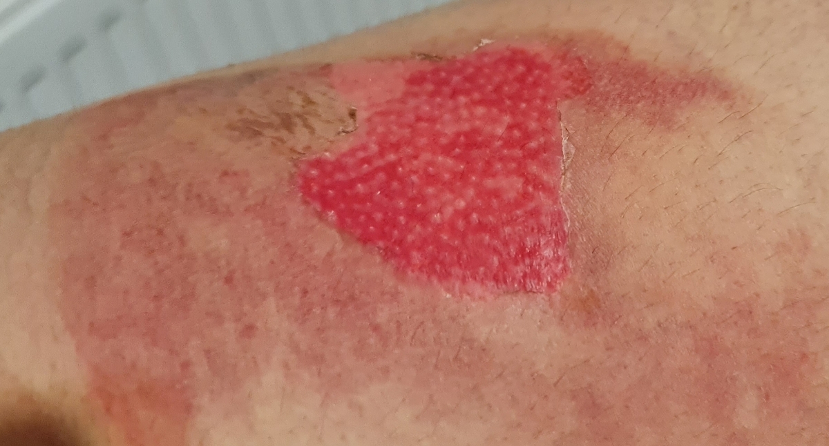 سوختگی با آبجوش در دوران شیردهی سوختگی با آبجوش در دوران شیردهی