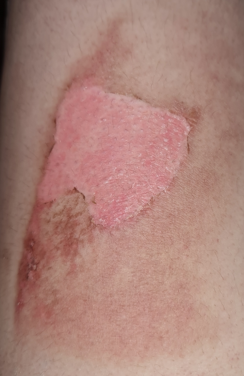 سوختگی با آبجوش در دوران شیردهی سوختگی با آبجوش در دوران شیردهی